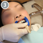 ホワイトニング専用ジェルを歯に塗っていきます。食品にも使われている成分なので安心して使用出来ます
