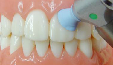 ホワイトニング施術前の歯面クリーニング